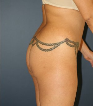 Lipo Flanks & Thighs, Fat to Buttocks - before - front