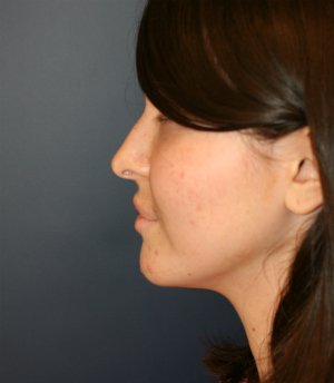 Implant at Base of Nose - before - front