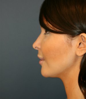 Implant at Base of Nose - after - front