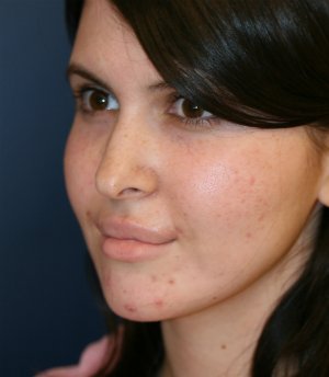 Implant at Base of Nose - before - oblique