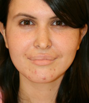 Implant at Base of Nose - before - side