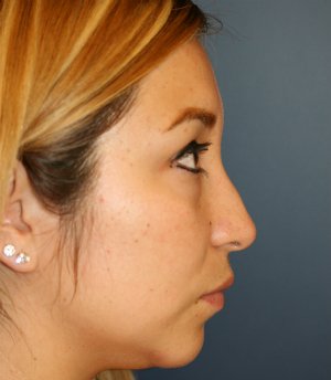 Feminizing Rhinoplasty 56 - before - front