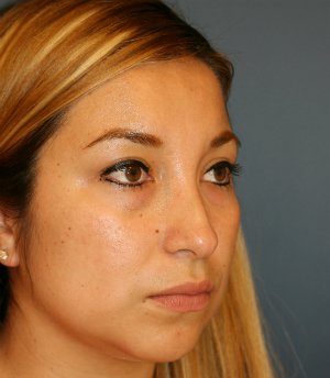 Feminizing Rhinoplasty 56 - before - oblique