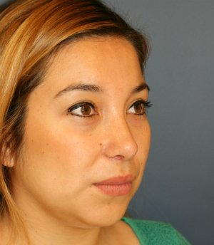 Feminizing Rhinoplasty 56 - after - oblique