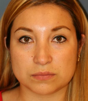 Feminizing Rhinoplasty 56 - before - side