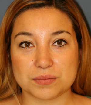 Feminizing Rhinoplasty 56 - after - side
