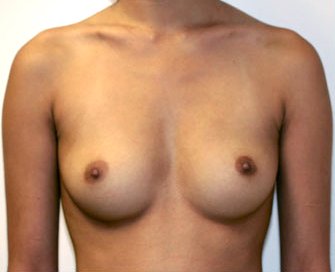 Breast Augmentation Case 10 - before - front
