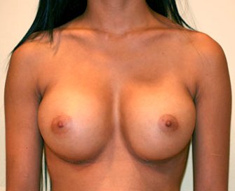 Breast Augmentation Case 10 - after - front