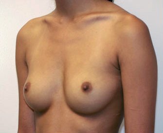 Breast Augmentation Case 10 - before - angle