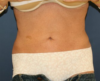 Tummy-Tuck-San-Diego-Revision-90 - before - front