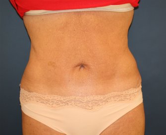 Tummy-Tuck-San-Diego-Revision-90 - after - front