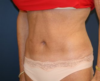 Tummy-Tuck-San-Diego-Revision-90 - after - oblique