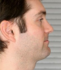 Necklift Case 1 - after - front