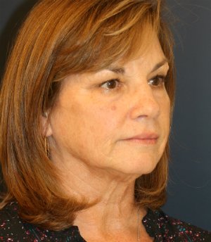 Anti-Aging Intervention (face-neck) - before - oblique