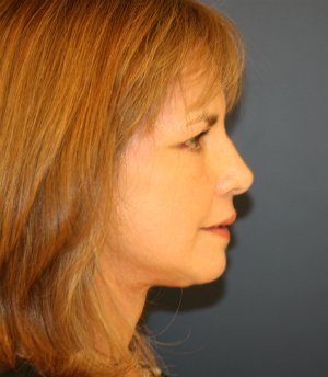Anti-Aging Intervention (face-neck) - after - side