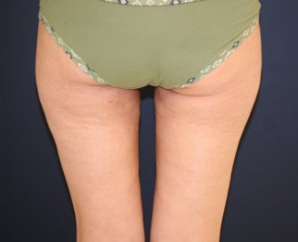 Liposuction Upper Inner Thighs - after - back
