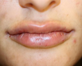 Lip Augmentation with Restylane Defyne - after - front