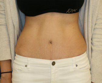 Tummy-Tuck-San-Diego-91 - after - front