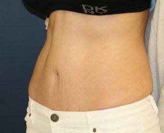 Tummy-Tuck-San-Diego-91 - after - oblique