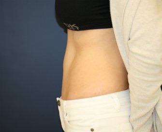 Tummy-Tuck-San-Diego-91 - after - side