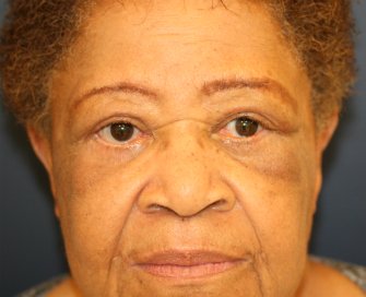 Upper and Lower Eyelid with Corner of Lip Lift - after - front