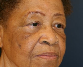Upper and Lower Eyelid with Corner of Lip Lift - before - oblique