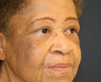 Upper and Lower Eyelid with Corner of Lip Lift - after - oblique