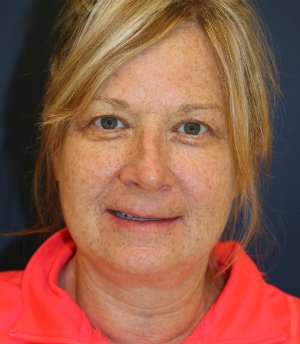Comprehensive Facial Rejuvenation - before - front