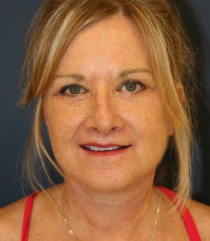 Comprehensive Facial Rejuvenation - after - front