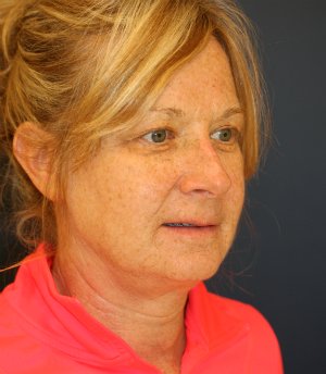 Comprehensive Facial Rejuvenation - before - oblique