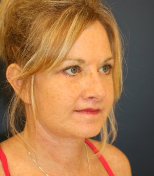 Comprehensive Facial Rejuvenation - after - oblique