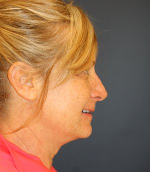 Comprehensive Facial Rejuvenation - before - side