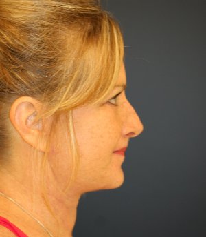 Comprehensive Facial Rejuvenation - after - side