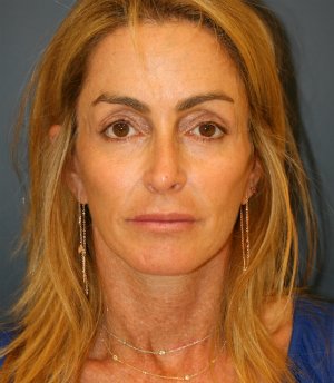Preventive Facial Rejuvenation - after - front