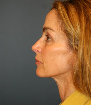 Preventive Facial Rejuvenation - before - side