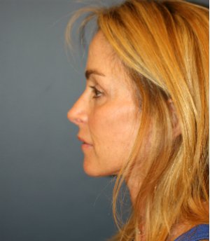 Preventive Facial Rejuvenation - after - side
