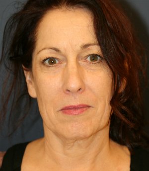 Facial Restoration Anti-Aging - before - front