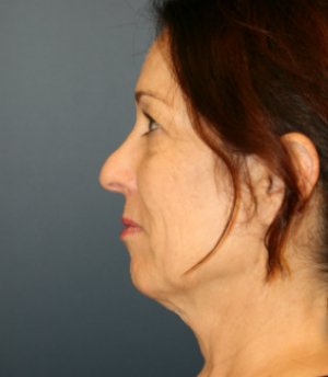 Facial Restoration Anti-Aging - before - side