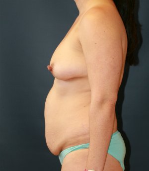 Breasts, Tummy, Flank Lipo - before - side