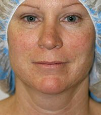 Necklift Case 2 - before - side