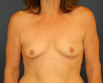 Natural Breast Augmentation San Diego 9 - before - front