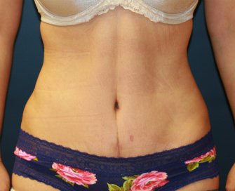 Tummy Tuck After Lipo San Diego - after - front
