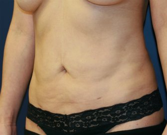 Tummy Tuck After Lipo San Diego - before - oblique