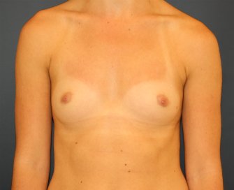 Breast Augmentation  San Diego - before - front