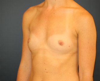 Breast Augmentation  San Diego - before - oblique