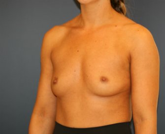 Breast Augmentation San Diego 400 cc - before - oblique