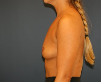 Breast Augmentation San Diego 400 cc - before - side