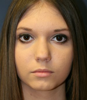 Rhinoplasty (for smaller nose) - before - front
