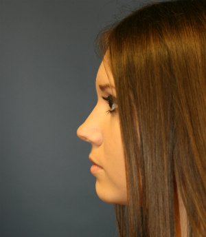 Rhinoplasty (for smaller nose) - before - side