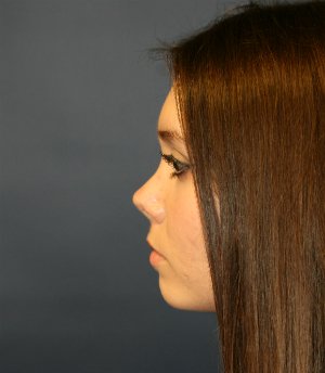 Rhinoplasty (for smaller nose) - after - side